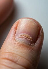 Fototapeta premium Damaged Fingernail: Close-up of a Cracked and Peeling Nail