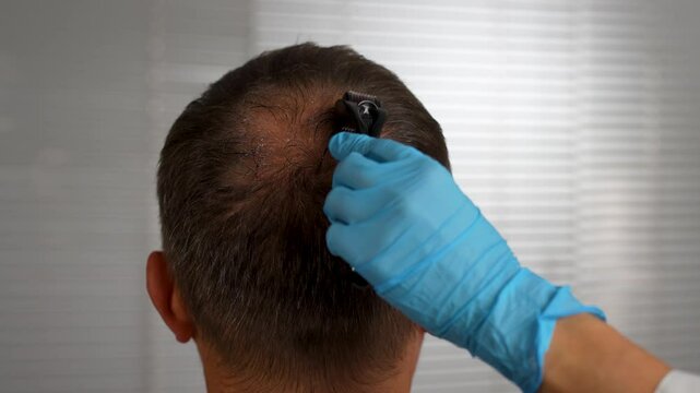 Hair Loss Treatment with Dermaroller Therapy and Oil Spray Bottle, close-up