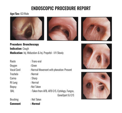 Bronchoscopy report of a 62-year-old Male patient