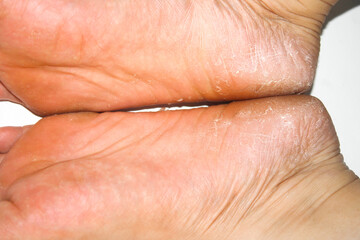 Close-Up View of Dry and Cracked Skin on Human Feet