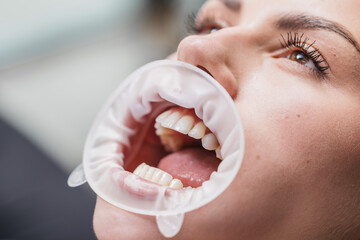 Young woman at the dentist's chair during a dental procedure. Overview of dental caries prevention....
