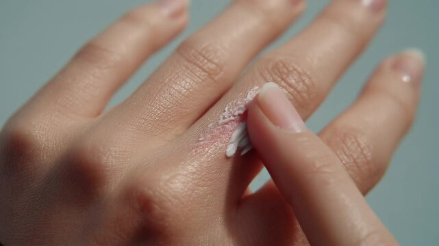 Macro view of a person applying soothing cream to a mosquito bite, irritated red skin with gentle finger motion, smooth cream texture on inflamed area, skincare treatment for insect bites