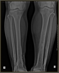 X-ray metal in conventional radiological examination of the cruris or tibia fibula bones