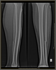 X-ray metal in conventional radiological examination of the cruris or tibia fibula bones