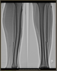 X-ray metal in conventional radiological examination of the cruris or tibia fibula bones