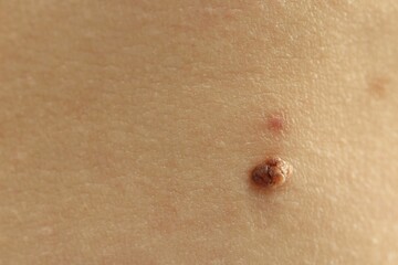 Woman with mole on her skin, closeup