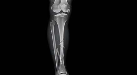 Naklejka premium Leg Fracture X-ray - Tibia and Fibula Broken
