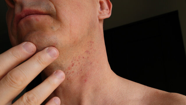 Skin irritation after shaving. Skin irritation on male neck after shaving. Close-up photo.