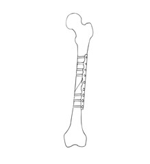 vector illustration of femur after internal fixation