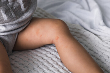 Allergic rash on the legs or feet of the toddler baby girl