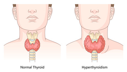 difference between a healthy thyroid gland and an enlarged thyroid affected by hyperthyroidism for educational use diagram hand drawn schematic vector illustration. Medical science educational.