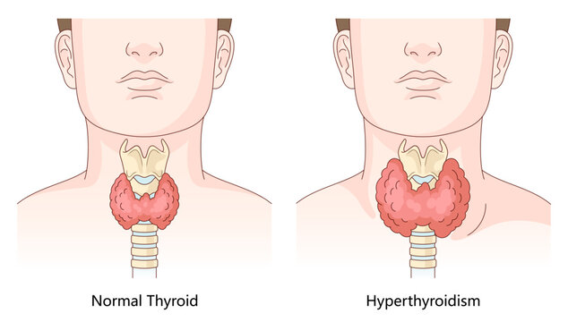 difference between a healthy thyroid gland and an enlarged thyroid affected by hyperthyroidism for educational use diagram hand drawn schematic vector illustration. Medical science educational.