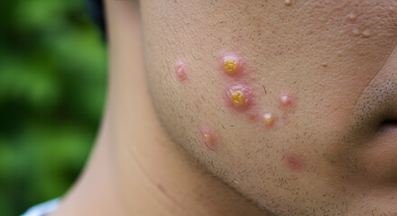 Fototapeta premium Close Up of a Man Face with Acne and Pustules Against Green Foliage Background Featuring Skin Inflammation