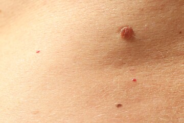 Man with moles on his skin, closeup