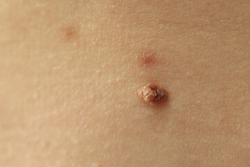 Woman with mole on her skin, closeup