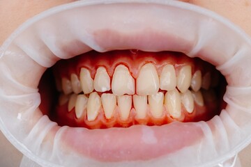 Dentist examining patient teeth using cheek retractor during dental procedure