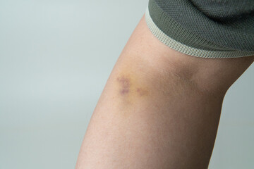 Close-up of a human arm showing a visible subcutaneous bruise near the elbow crease, likely caused...