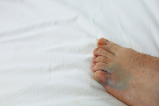 Male foot with a broken bone and bruising on the simple, white background