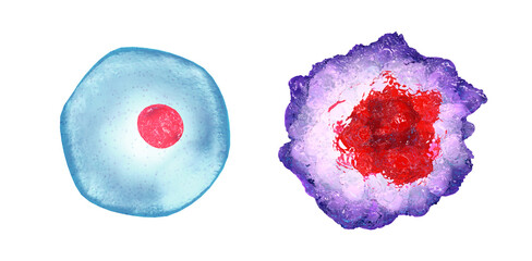 Healthy cell (left) and Cancer cell (right) side by side. Cancer cells have larger, deformed or multiple nuclei, smaller cytoplasm and abnormal shape