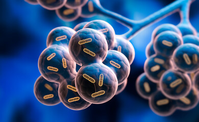 Detailed medical 3D illustration of alveoli in the lungs, bronchiole infected with bacteria	
