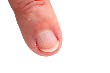 Close up of a fingernail with ridges