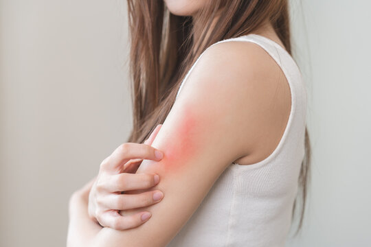 Dermatology asian young woman, girl allergy, allergic reaction from atopic, insect bites on arm, hand in scratching itchy, itch red spot or rash of skin. Healthcare, treatment of beauty on background.