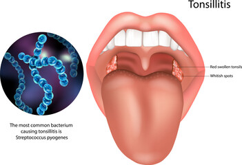 The image also highlights Streptococcus pyogenes, the most common bacterium responsible for bacterial tonsillitis. 

