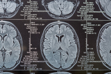 Magnetic resonance imaging or MRI image of the brain