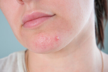 Purulent pimple on a woman's face.