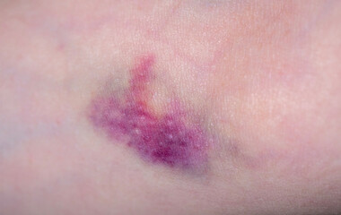 Fototapeta premium bruise on female hand skin, hematoma on elbow area from blood draw, hurt mark, medical treatment, symptom medical condition, body pain, Health care