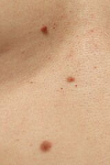 Man with moles on his skin, closeup