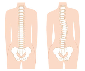 背骨の歪み　正常な背骨　