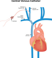 Central Venous Catheter Placement Anatomy Diagram