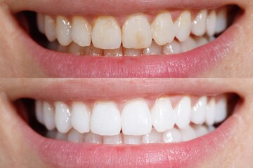 Before and after teeth whitening comparison.