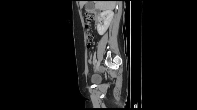 Explore the role of CT scans in diagnosing appendicitis and gallstones.