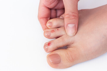 Woman suffering from calluses on her toes, formed after walking in uncomfortable shoes