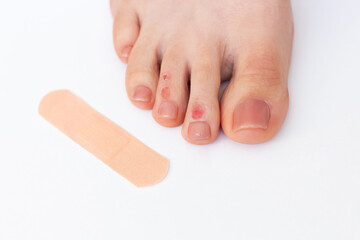 Woman's foot with calluses on her toes, formed after walking in uncomfortable shoes, using a patch...