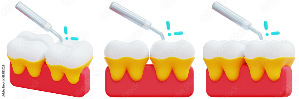 Poster set of 3d render of teeth cleaning process: scaling and stitching 3d render icon illustration