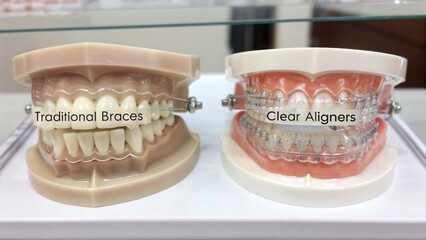 Visiting a speciality doctor dentists Orthodontist Models of traditional braces and clear aligners displayed for comparison in a dental setting.