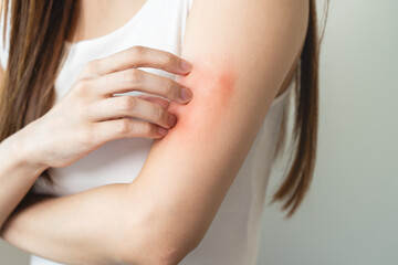 Sensitive skin allergic concept, Woman itching on her arm have a red rash from allergy symptom and...