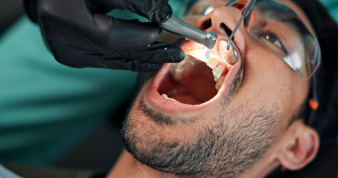 Man, hands or dentist with drill for tartar, bacteria or germ removal at orthodontist. Closeup, male person or patient with surgeon cleaning plaque teeth for gum disease or tooth extraction at clinic