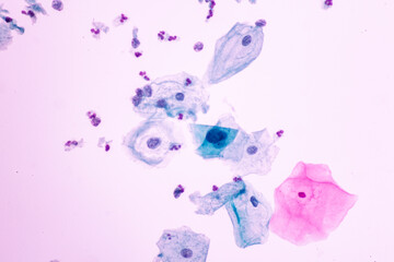View in microscopic of koilocyte cell criteria of HPV (Human Papilloma virus) infection.Abnormal squamous epithelial cells view in microscopy.HPV criteria for pap smear slide cytology.Pap smear