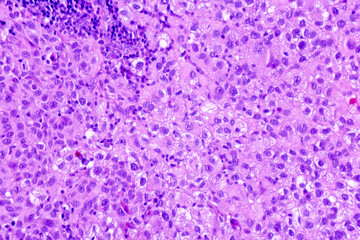 Backgrounds of human cells tissue of lung human under the microscope in pathology lab.View in...