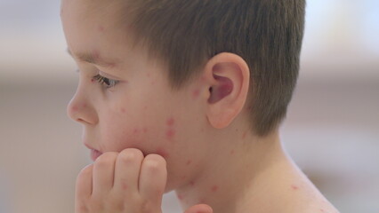 A Child with a Skin Condition chickenpox Profile Side View Displaying Unique Features and Symptoms