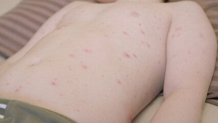 Young child with a skin rash chickenpox on their back is lying down, appearing uncomfortable and...