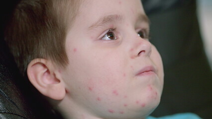 A young child exhibiting skin rash chickenpox symptoms that raise concerns requiring attention