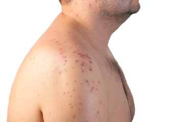 Red spots and rashes on the skin of the back and shoulders after drinking alcohol. Anaphylactic...