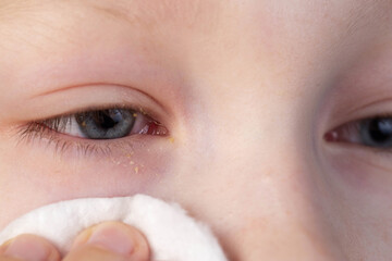 A girl wipes her eyes with a cotton pad to remove pus from her eyes due to conjunctivitis. Bacterial infection, close-up