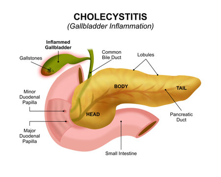 Cholecystitis (Gallbladder Inflammation) Gallstones illustration