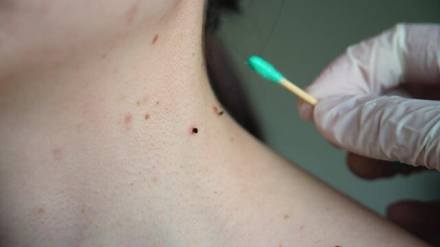 Cauterization of hanging papillomas on the neck